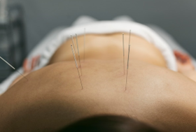THEPAPEUTIC ACUPUNCTURE